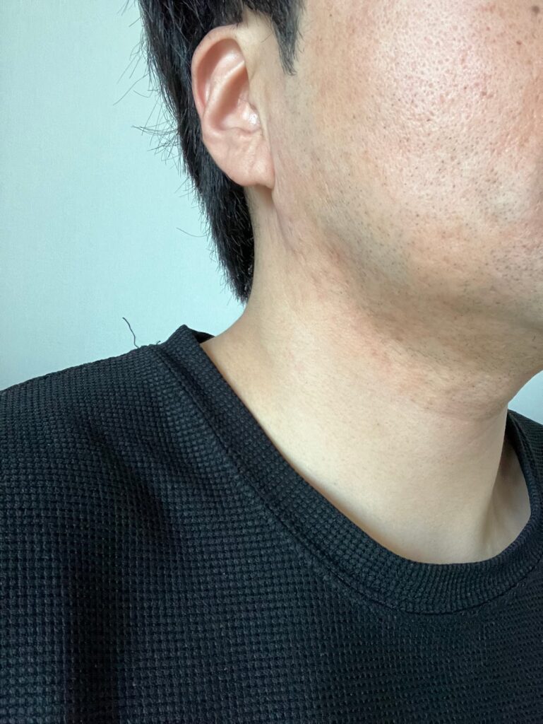 모낭염 완치후 시간이 1년정도 흐른뒤 좌측 사진(보정없는 원본사진)